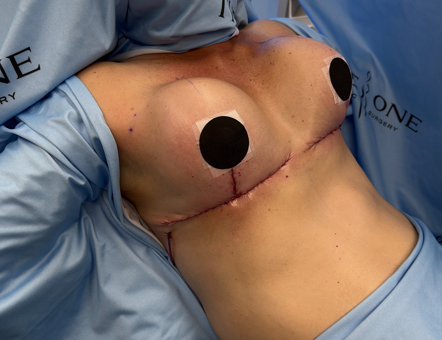 Surgical site after breast augmentation procedure.