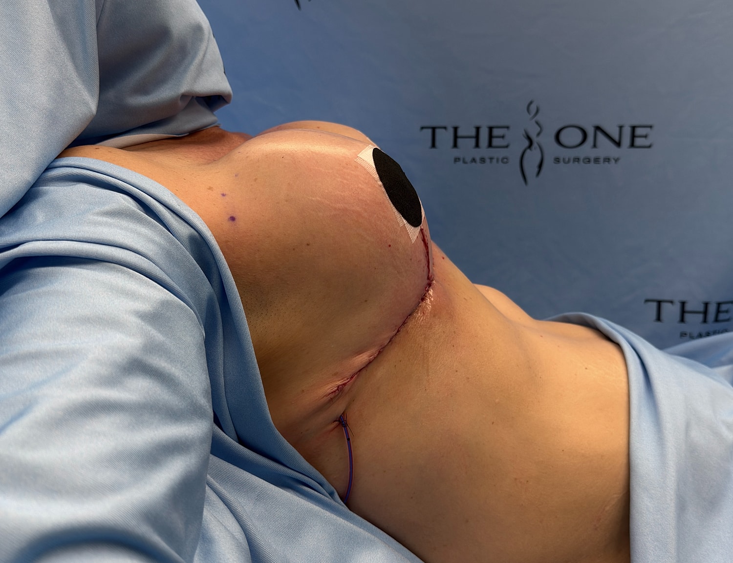 Surgical site with stitches and draped fabric.