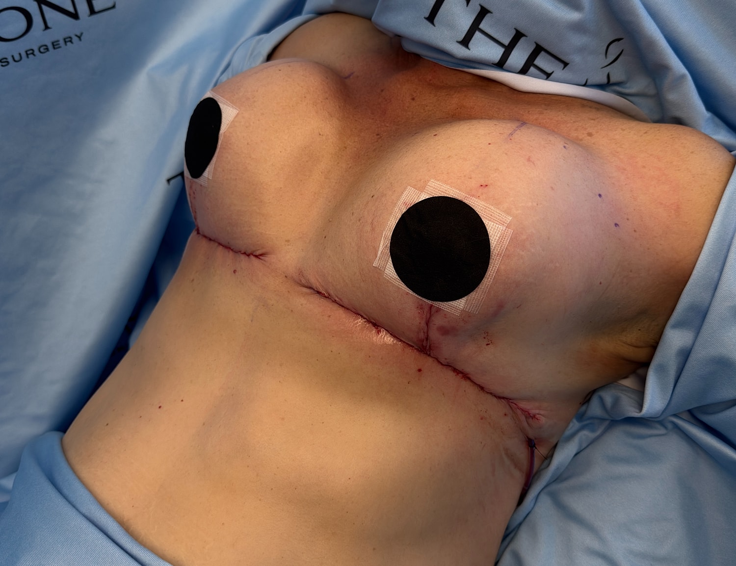Post-surgery chest area with surgical dressings.