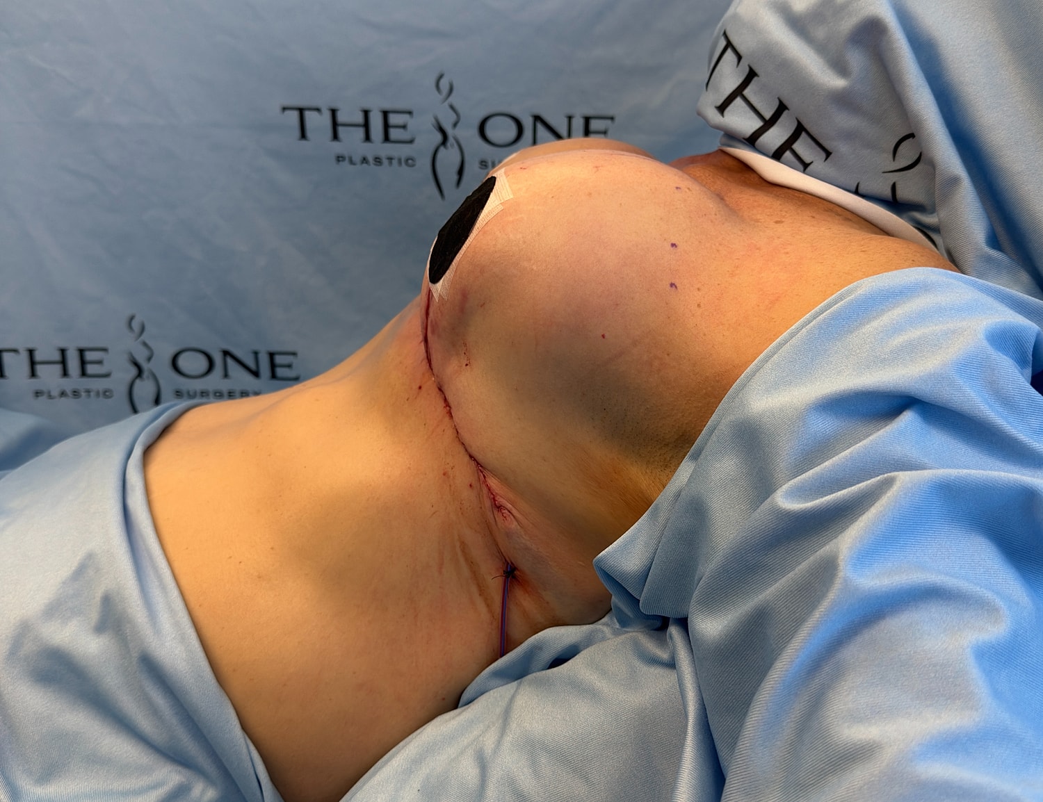 Post-surgery view of breast augmentation procedure.