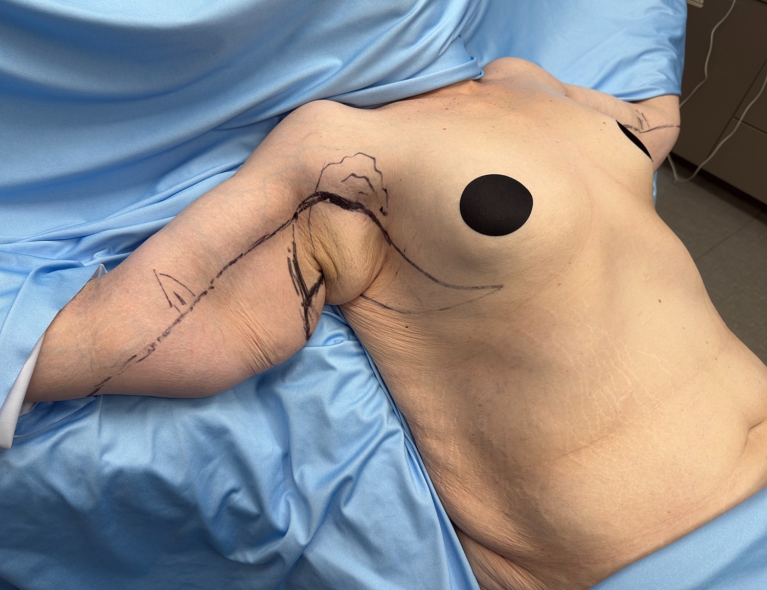 Patient preparation for surgical procedure on upper body.