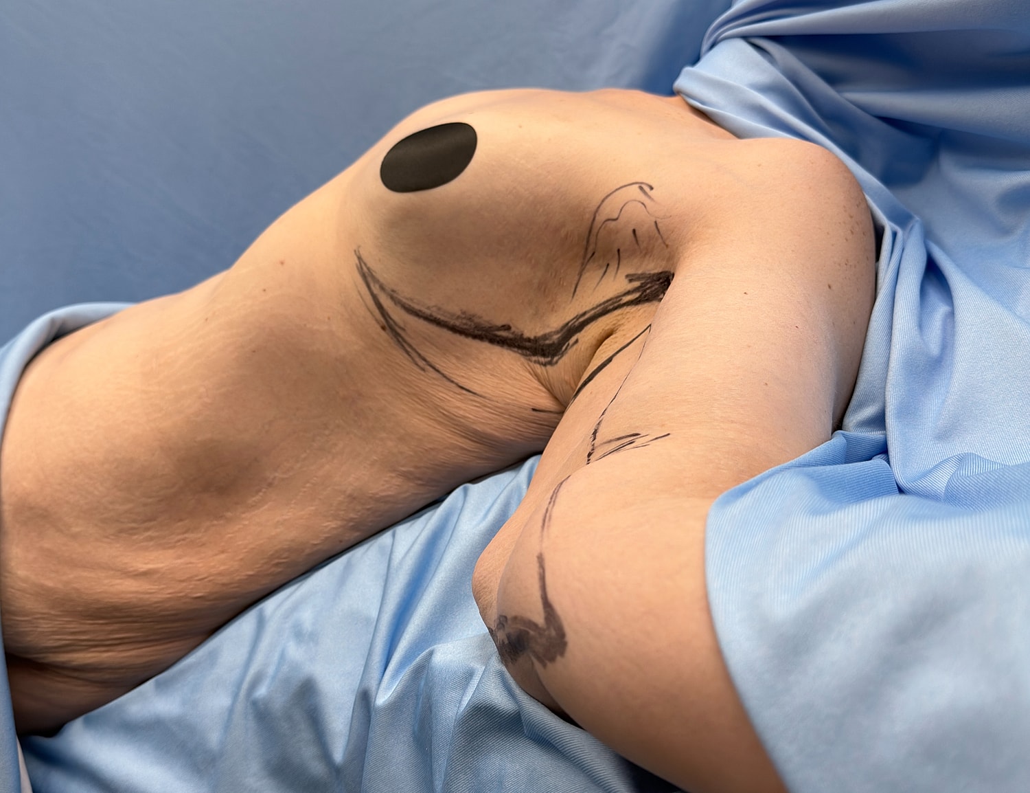 Surgeon's markings on a patient's arm.
