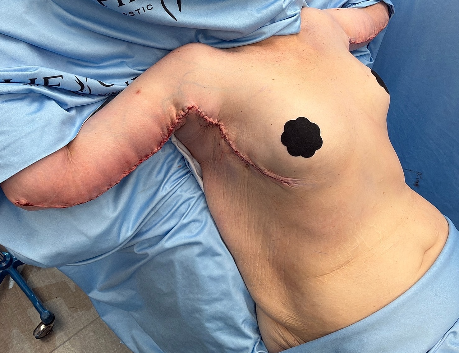 Post-surgery body with visible scars and dressings.