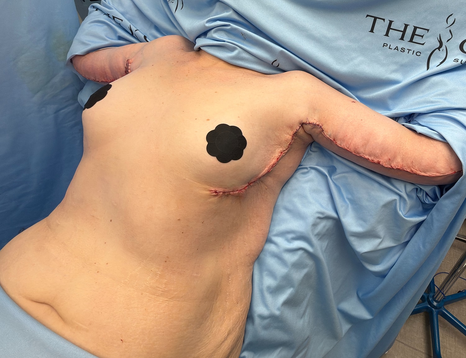 Post-surgery abdomen with visible stitches and coverings.