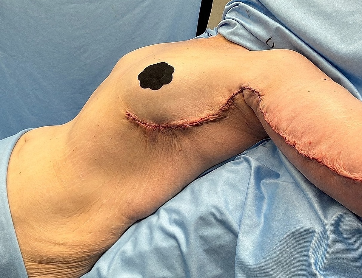 Post-surgery recovery with visible surgical scars.