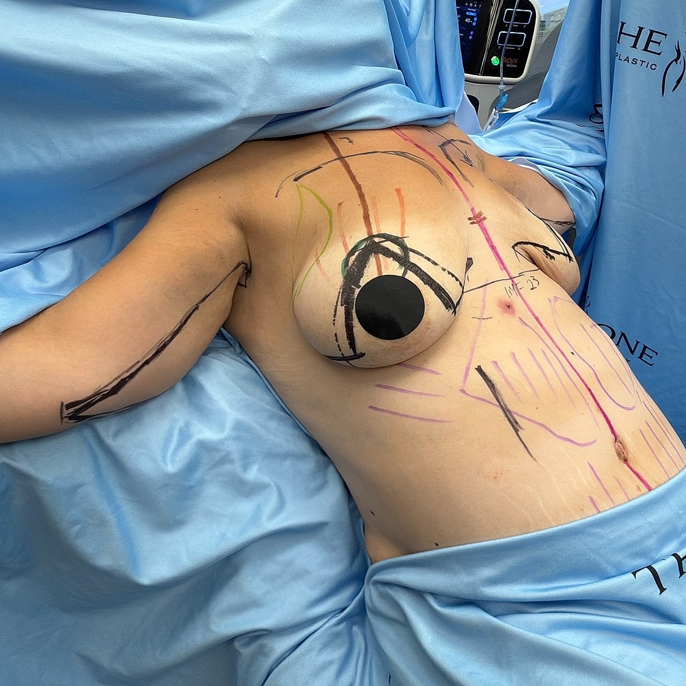 Body marking for plastic surgery procedure preparation.
