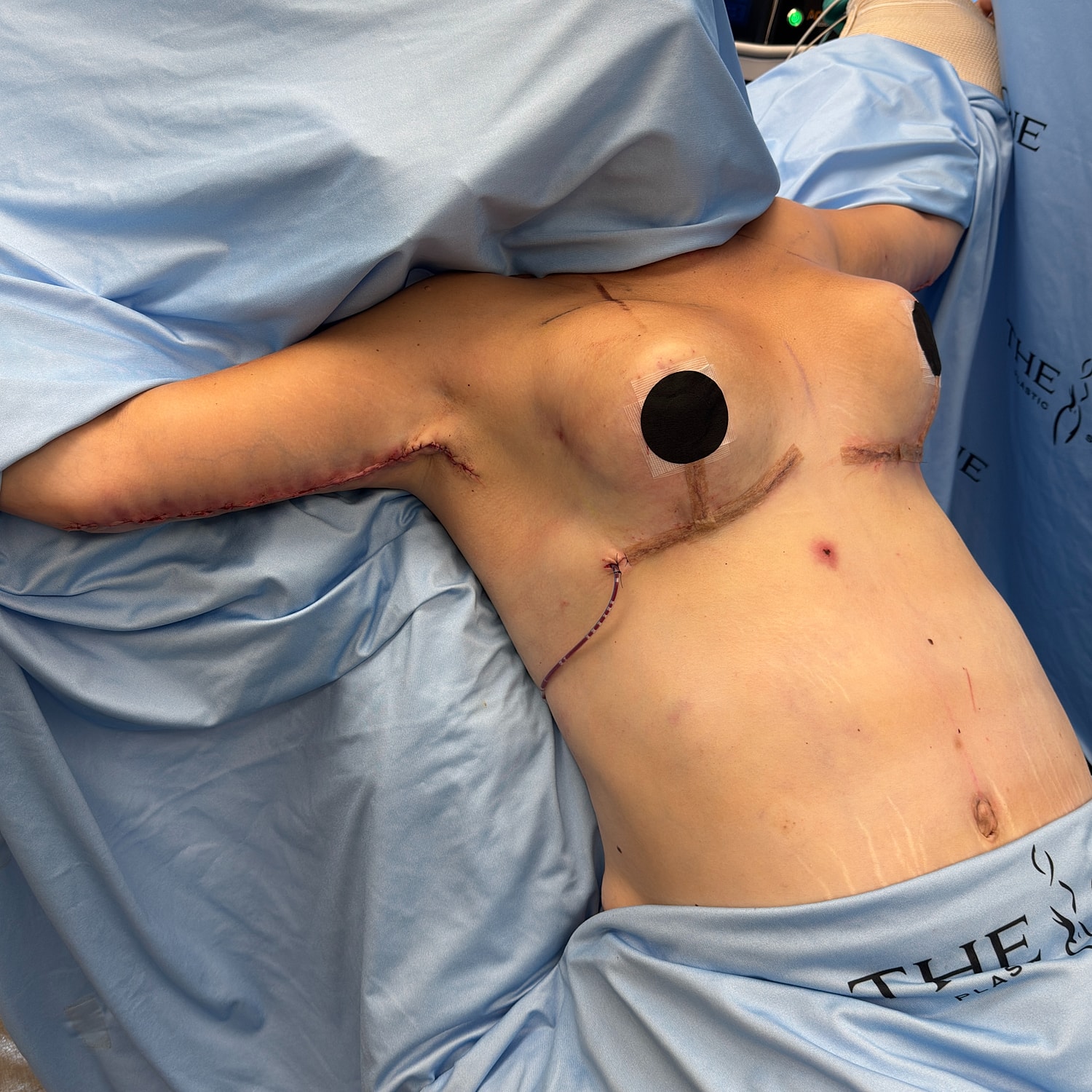 Post-surgery torso with stitches and dressings.