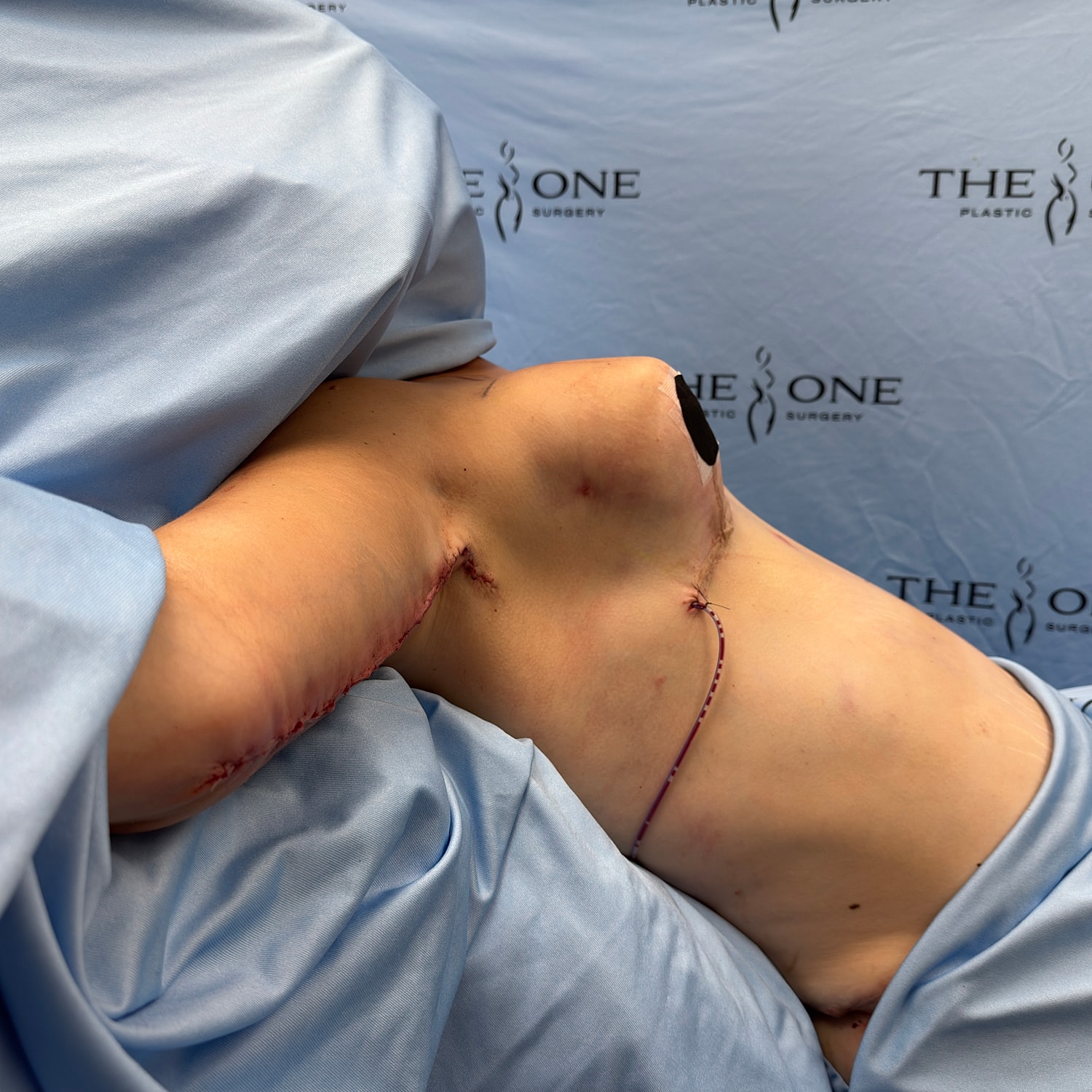 Patient post-surgery with visible sutures and recovery.