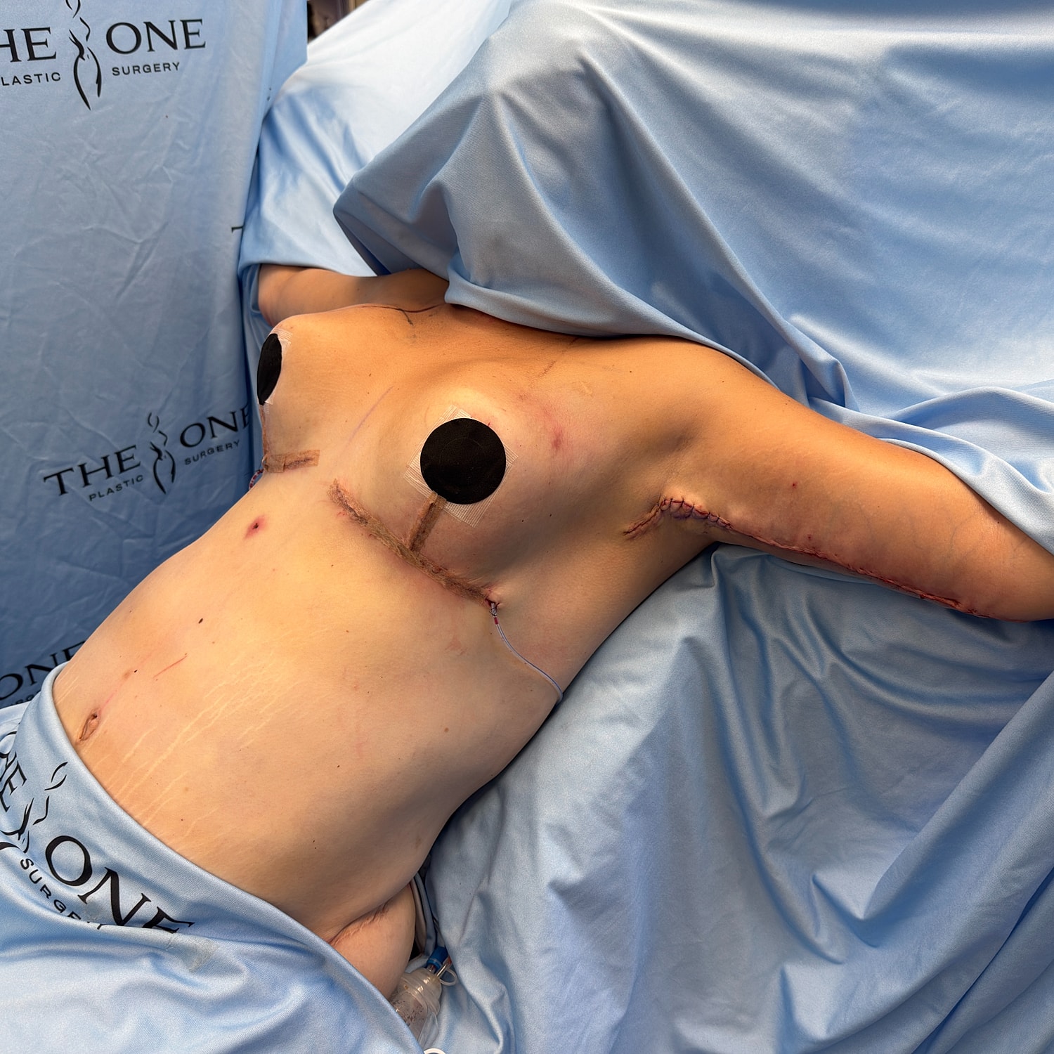 Post-surgery recovery with visible incision marks.