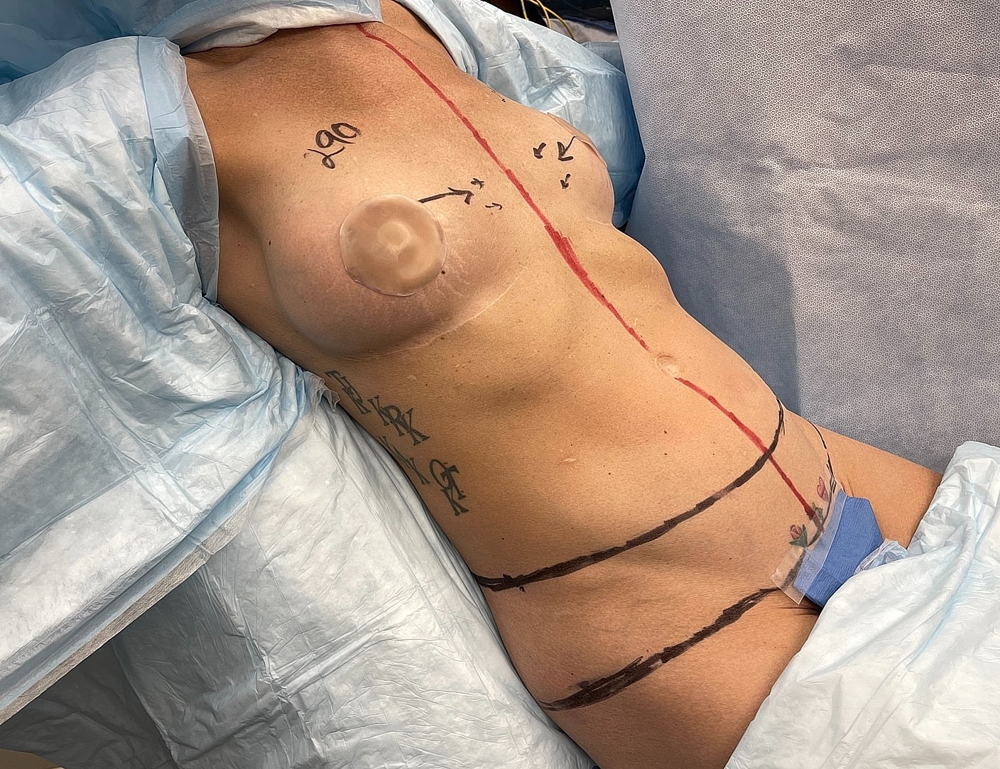 Body with markings, surgical preparation in progress.