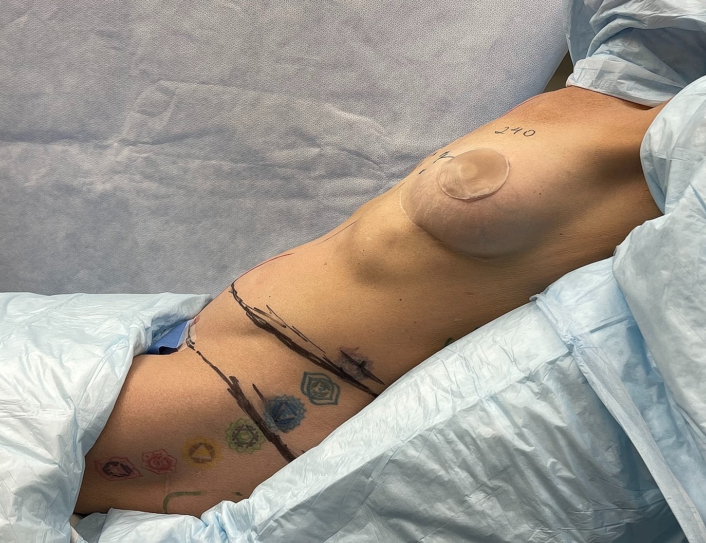 Medical image of a torso with markings.