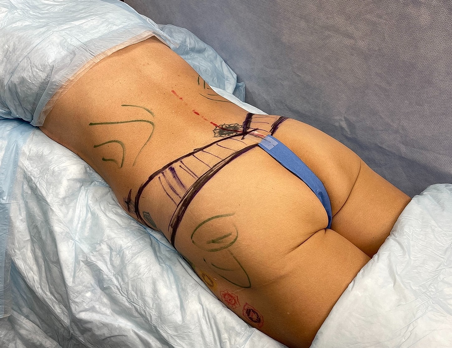 Body markings on a patient in medical setting.