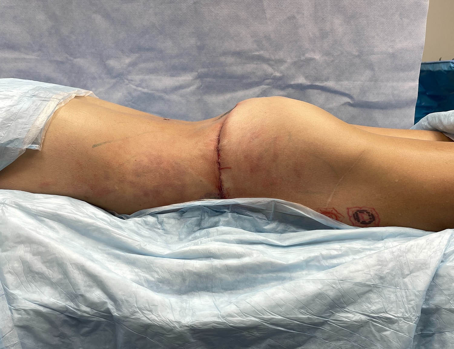 Surgical site on patient’s back view.