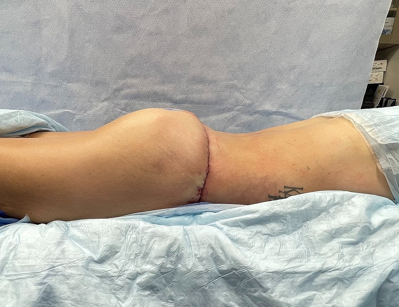 Post-surgery patient lying on operating table