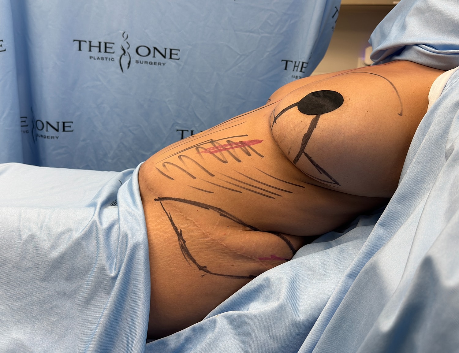 Pre-surgery markings on a patient’s torso.