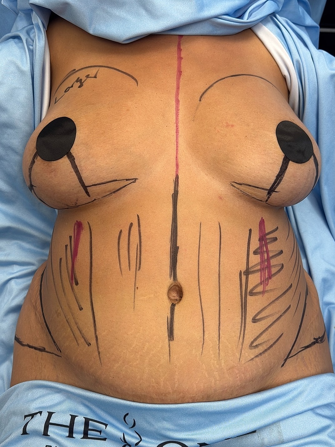 Surgical markings on torso prior to procedure