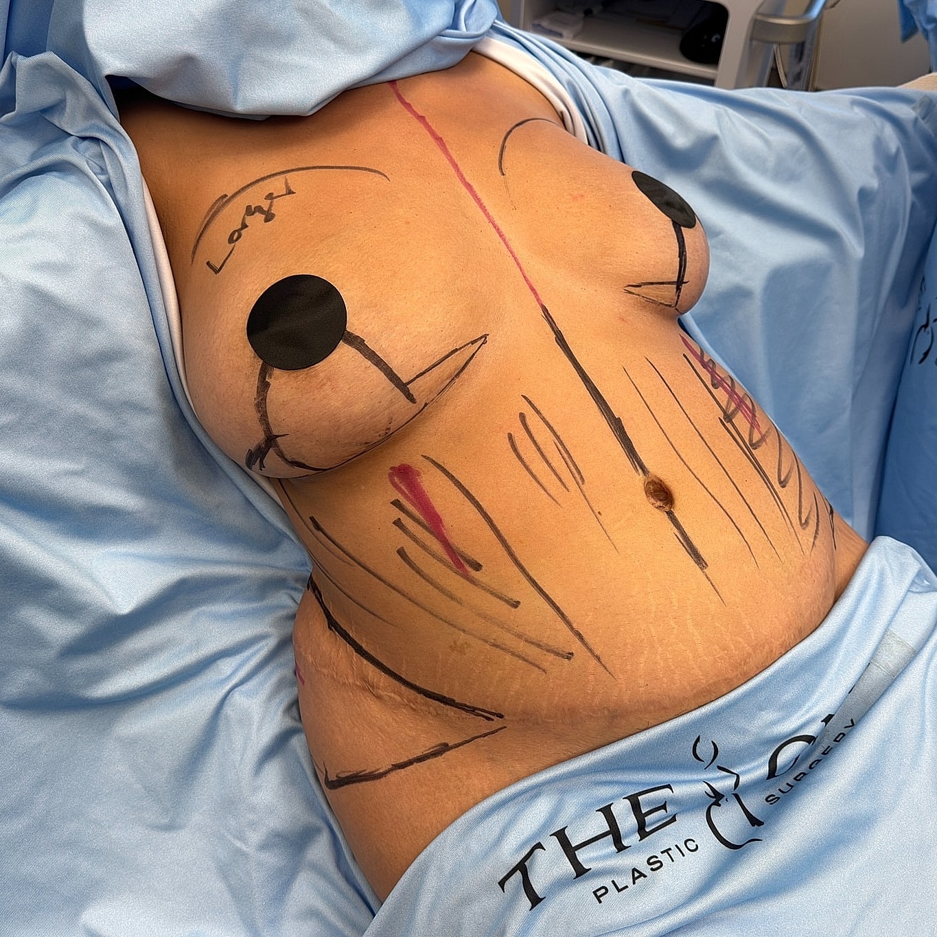 Patient preparation for surgery with markings.