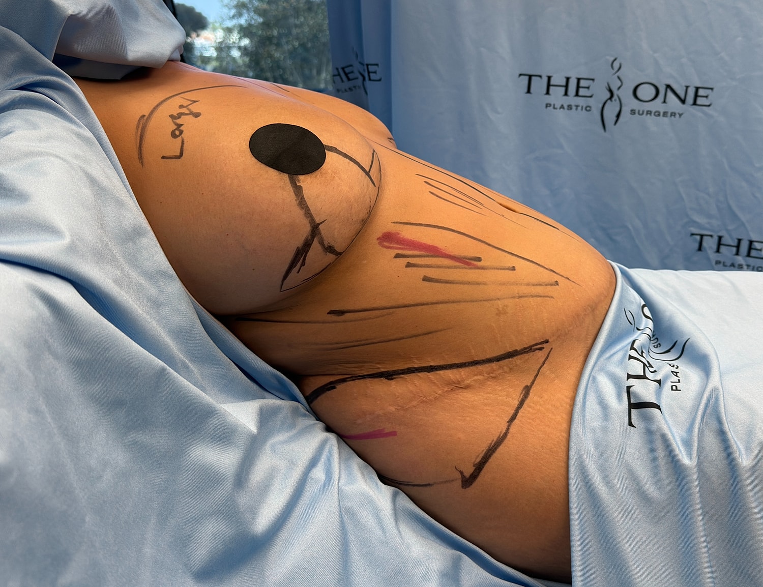 Marked body for plastic surgery preparation.