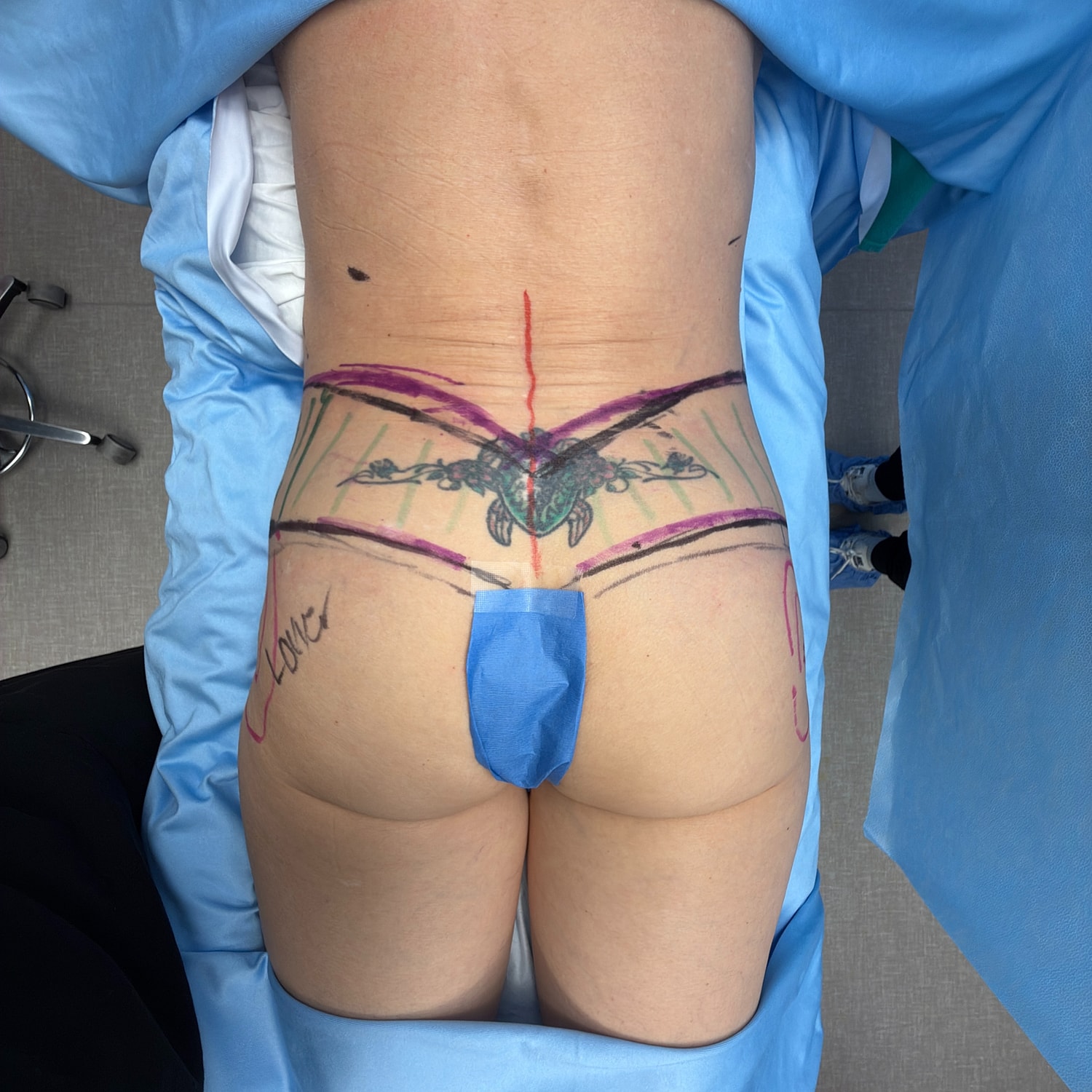 Marked skin before body contouring procedure.