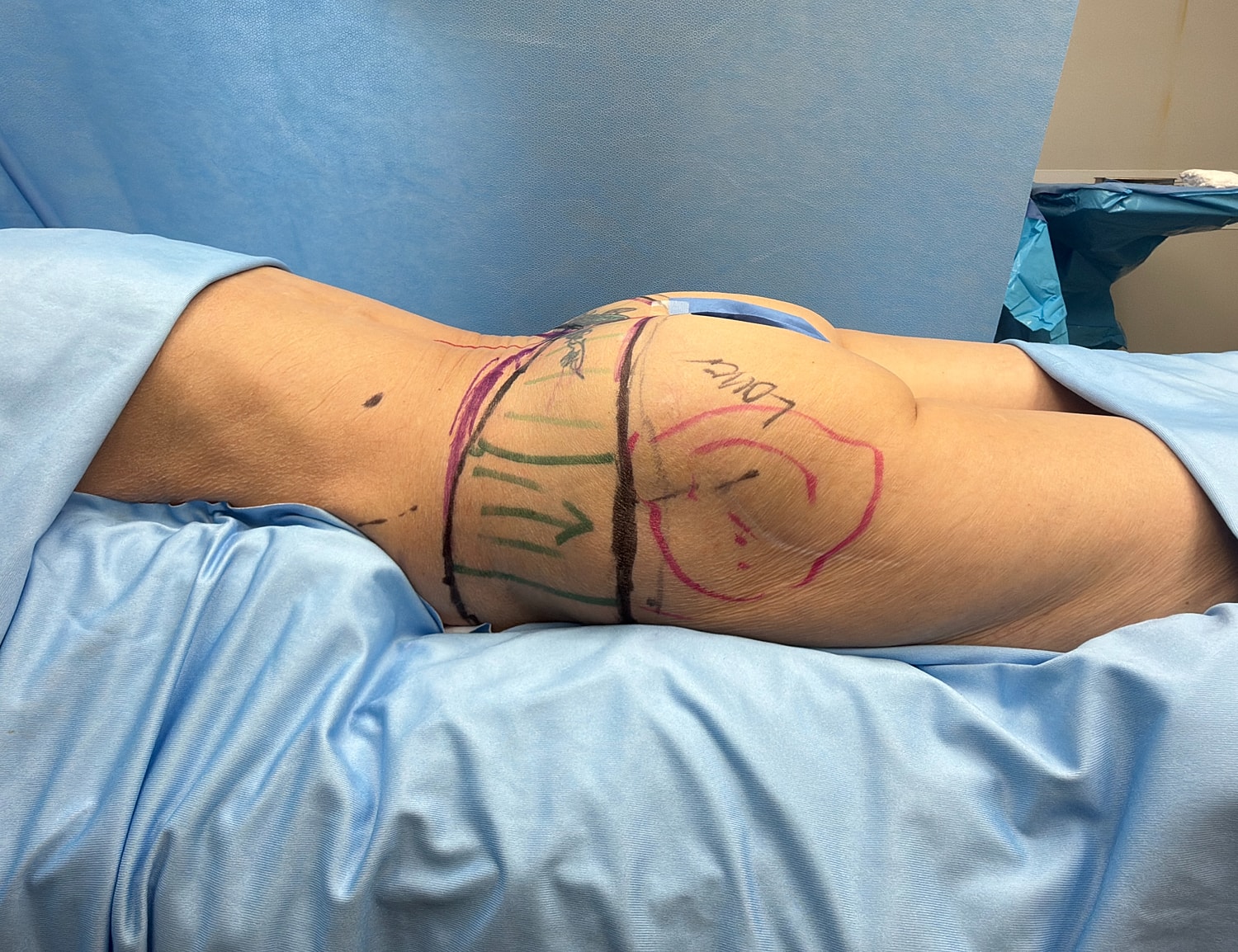 Surgical markings on bare skin during procedure.