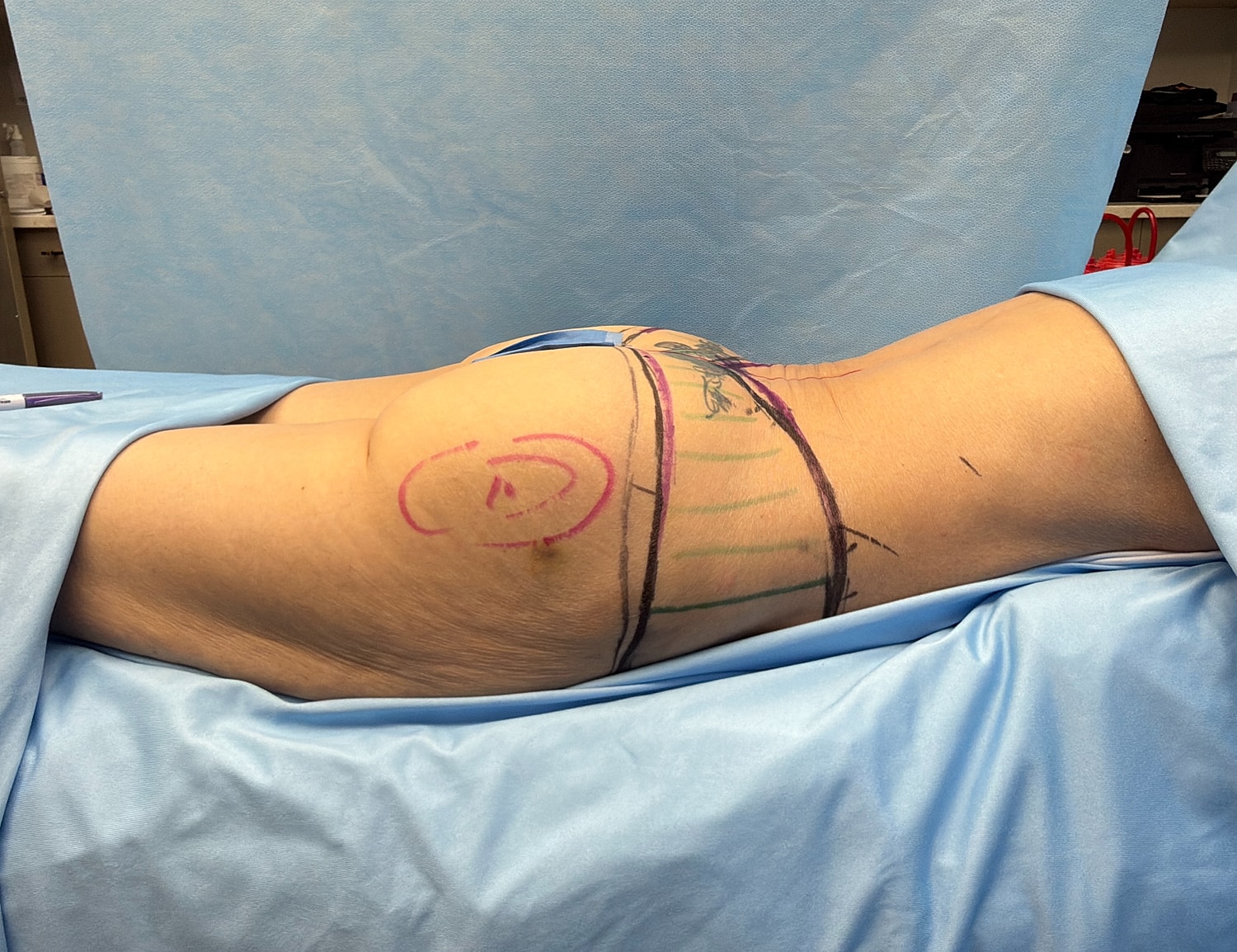 Patient preparation for a medical procedure.