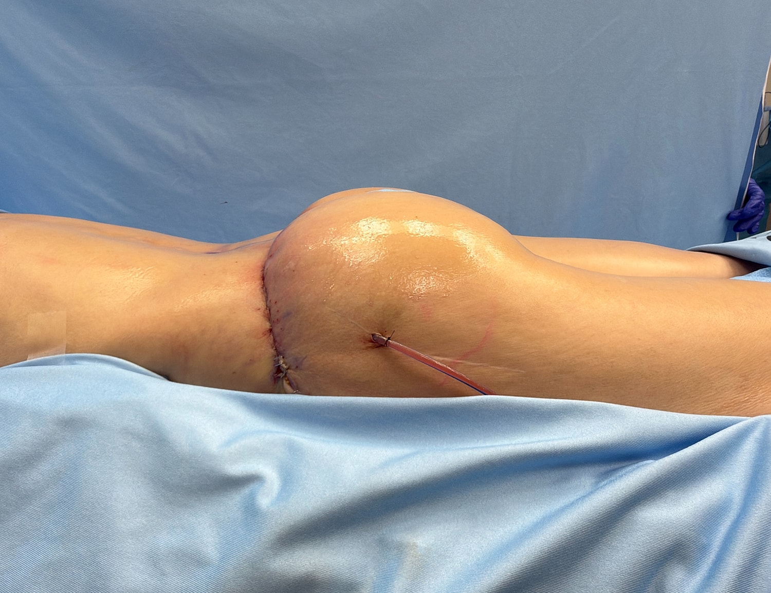 Post-surgery view of stitched body contour.