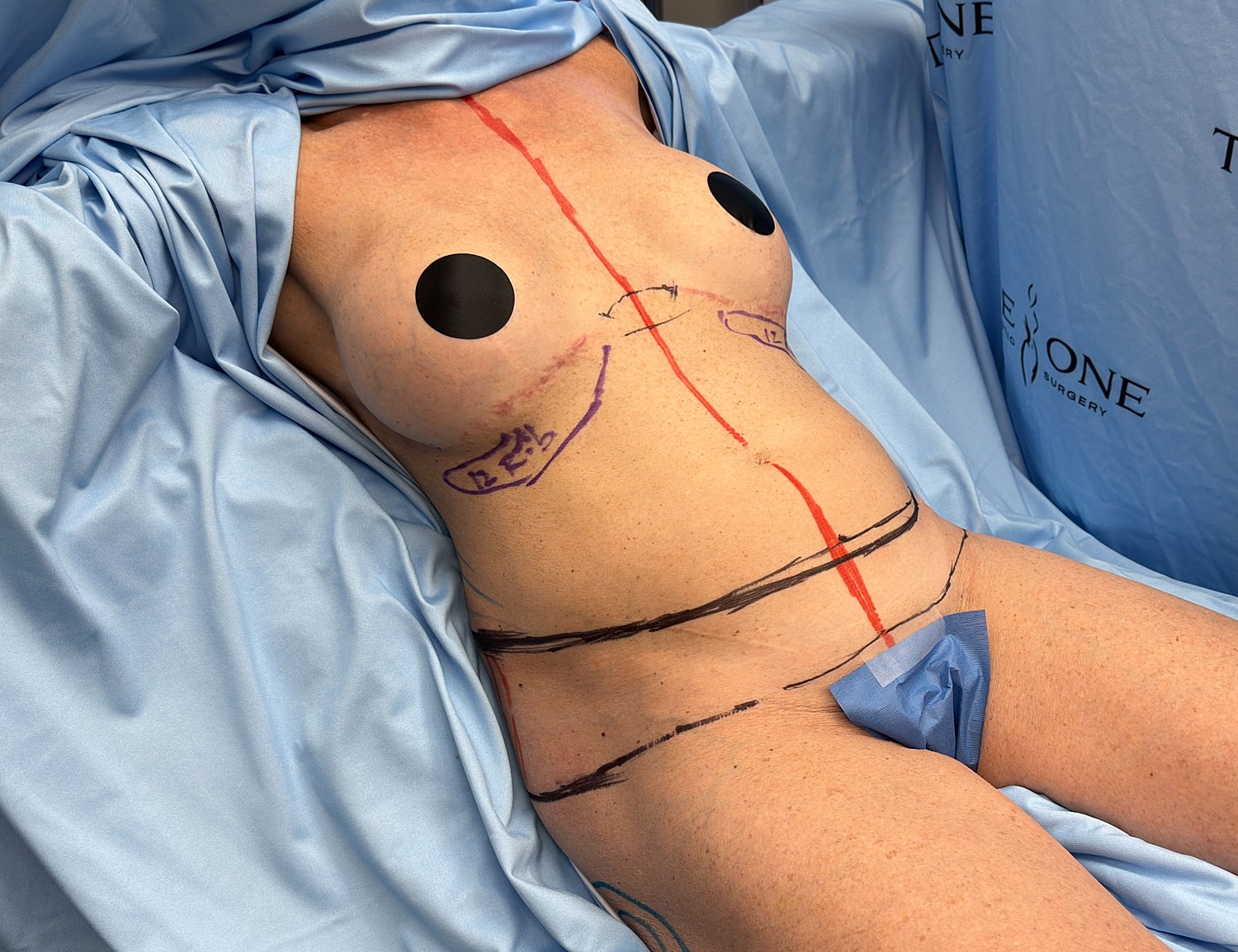 Pre-operative body marking for surgical procedure.