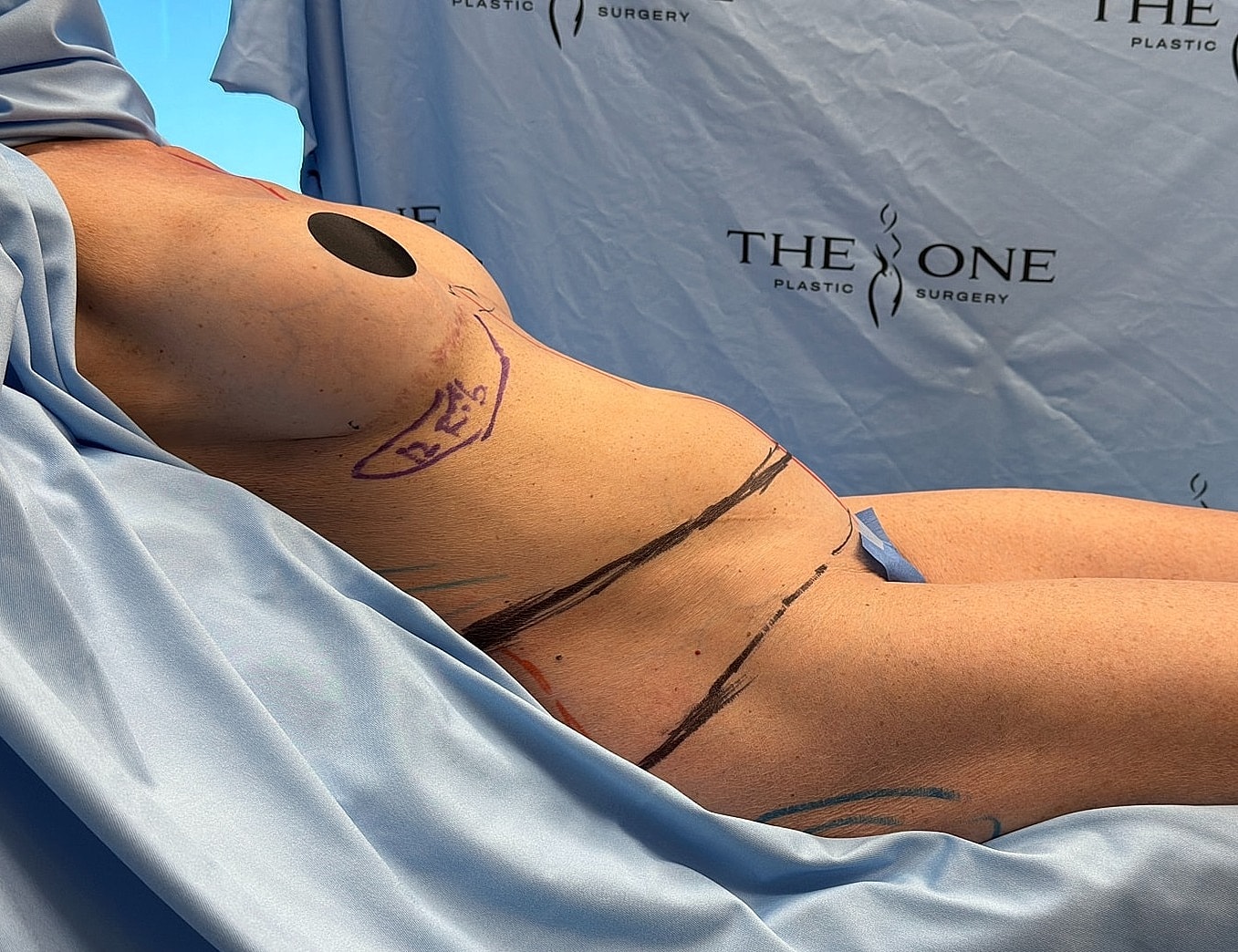 Body preparation for plastic surgery procedure.