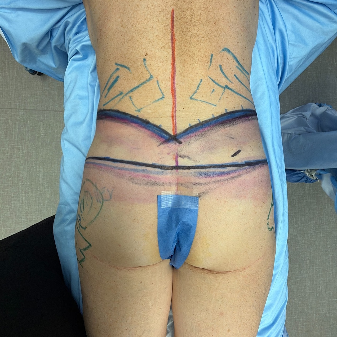 Back with markings for medical procedure preparation.