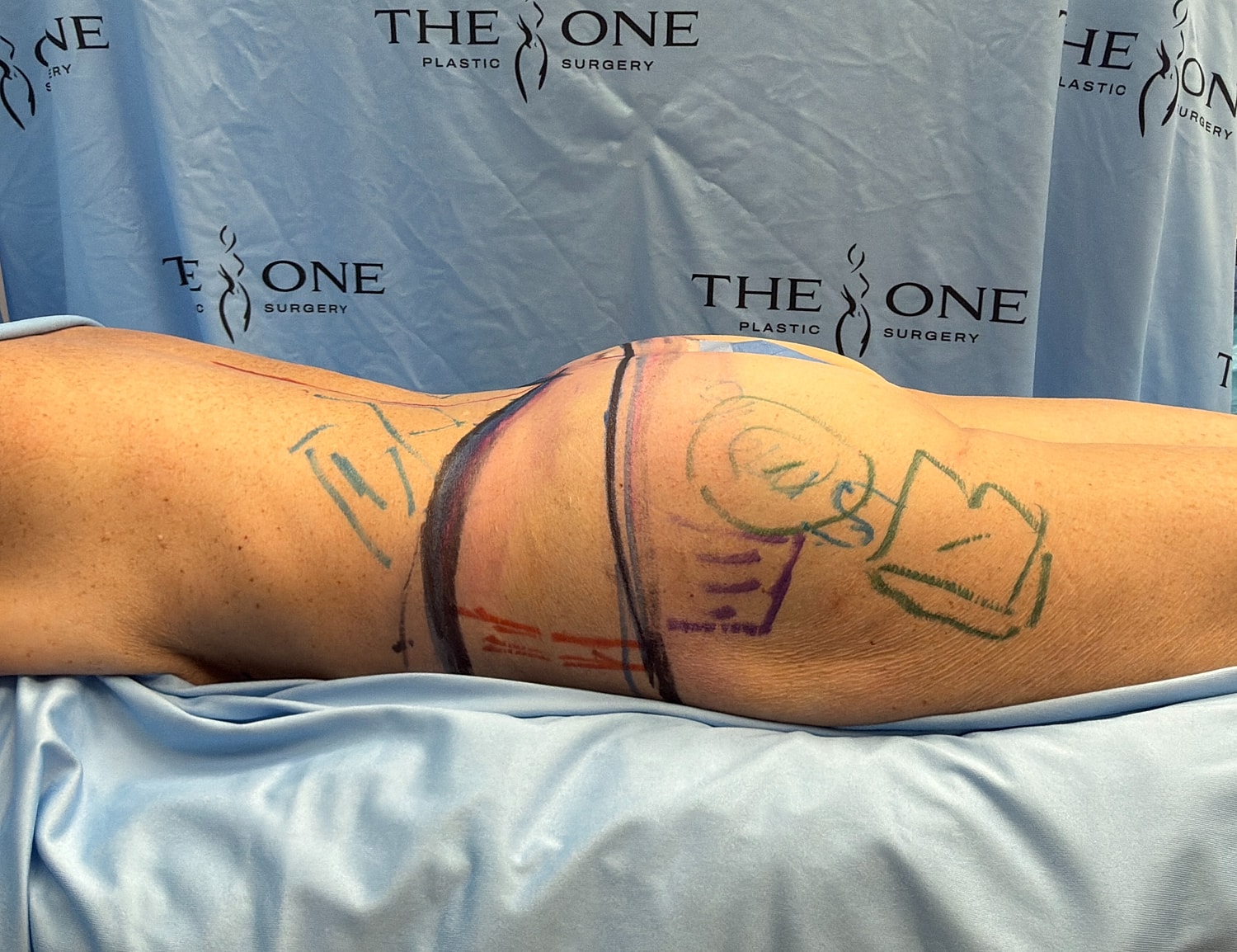 Patient's side with surgical markings for procedure.