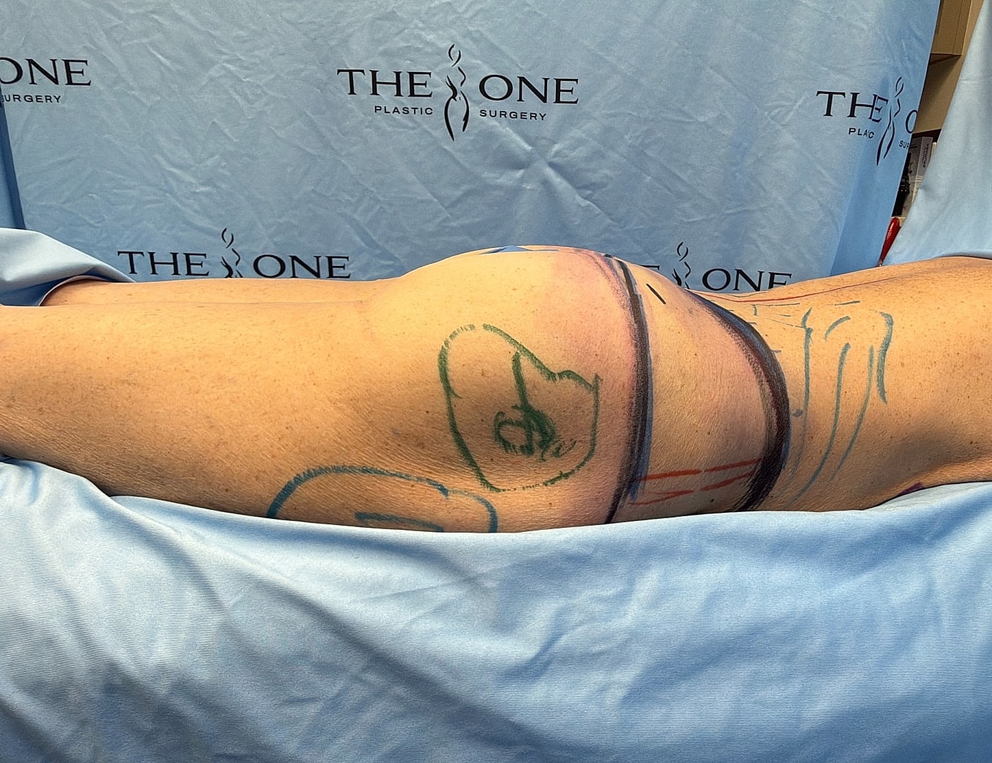 Patient's body with markings for plastic surgery procedure.