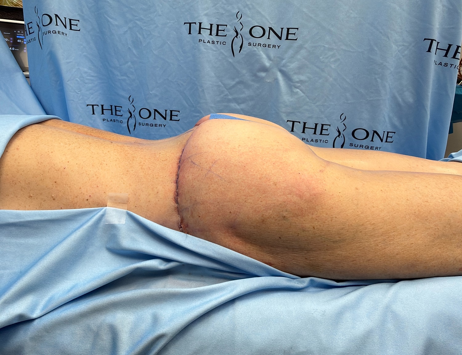 Post-surgery recovery view of a patient's side.