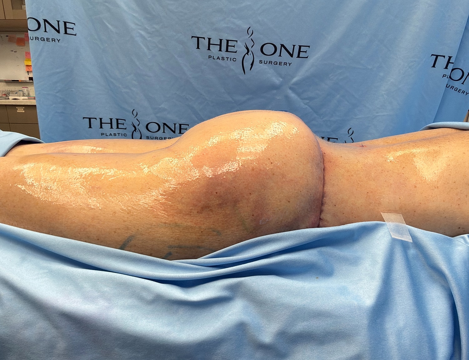 Patient preparing for plastic surgery procedure.