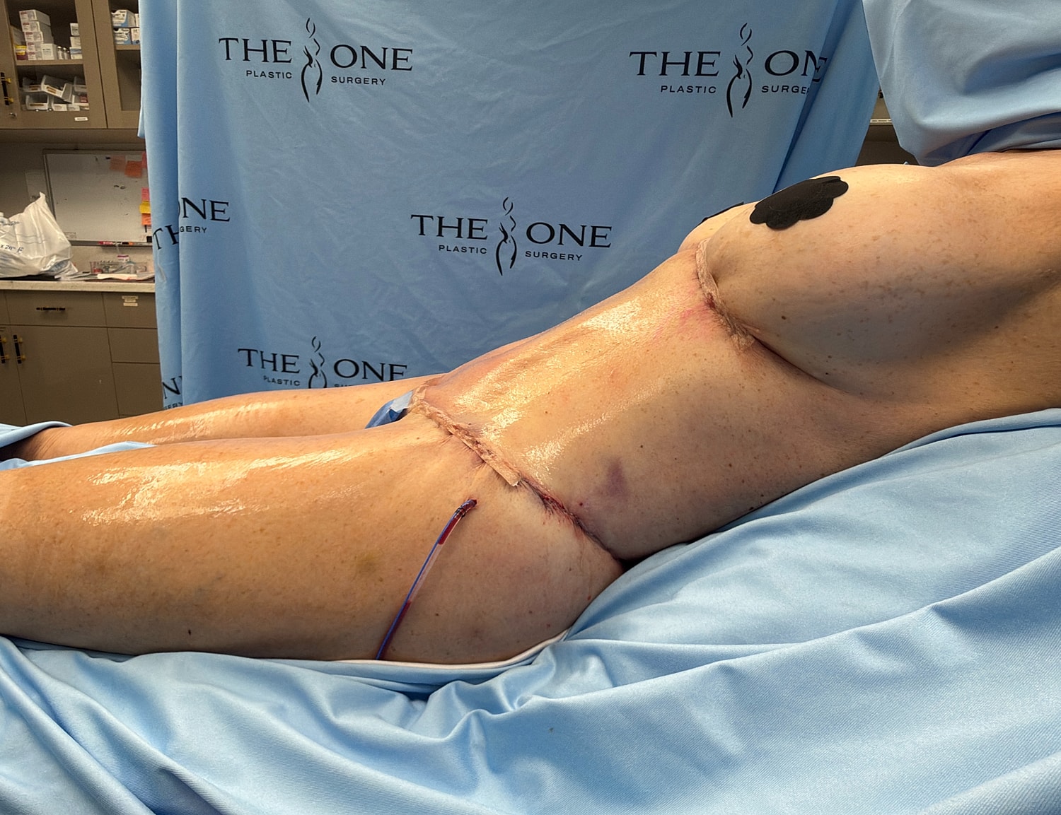 Post-surgery recovery photo with visible stitches.