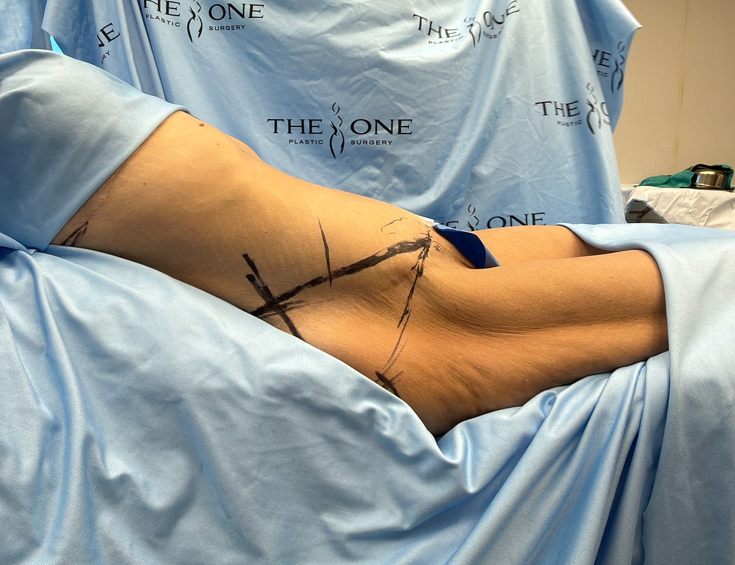 Patient preparing for plastic surgery procedure.