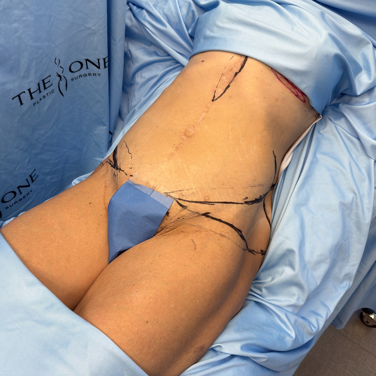 Visible markings on body for surgical procedure.