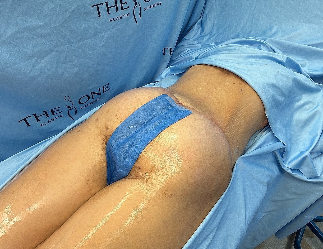 Post-surgery recovery on a surgical bed.
