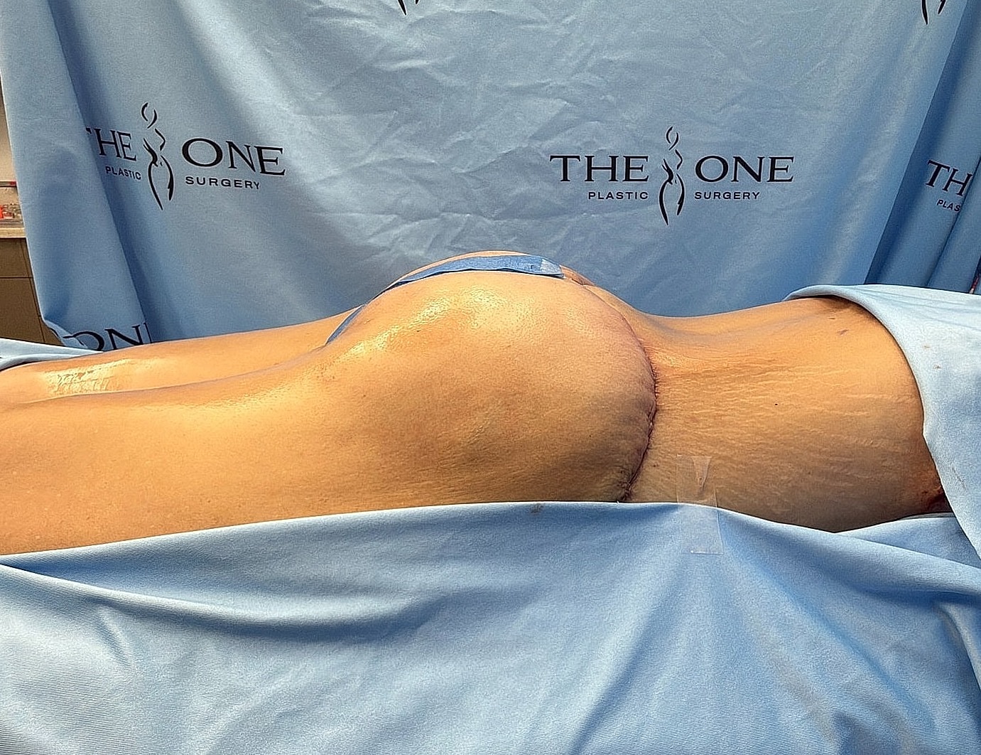 Patient on operating table after surgery.