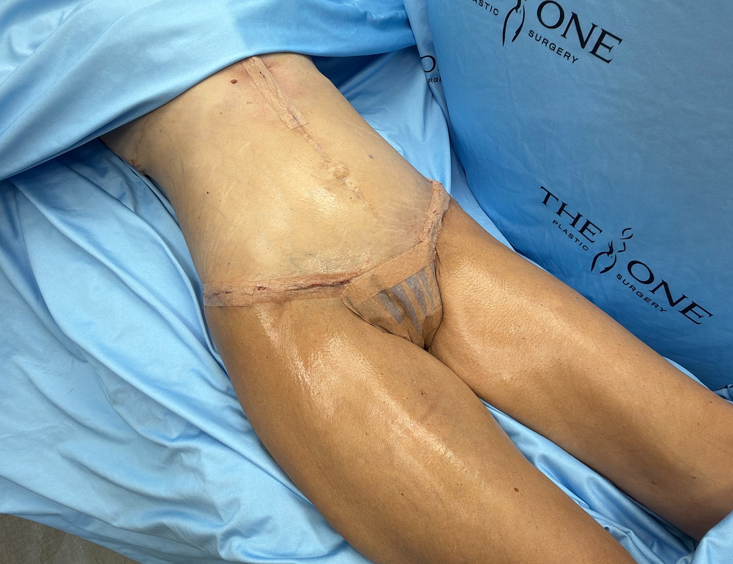 Post-surgery patient on surgical table.