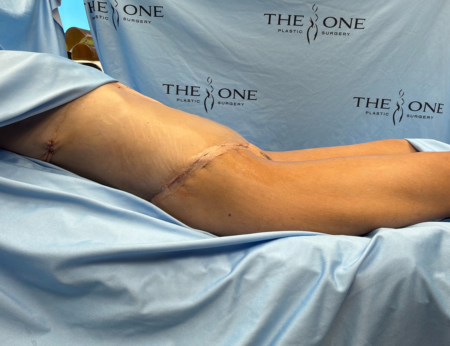 Post-surgery leg with stitches and recovery drape.