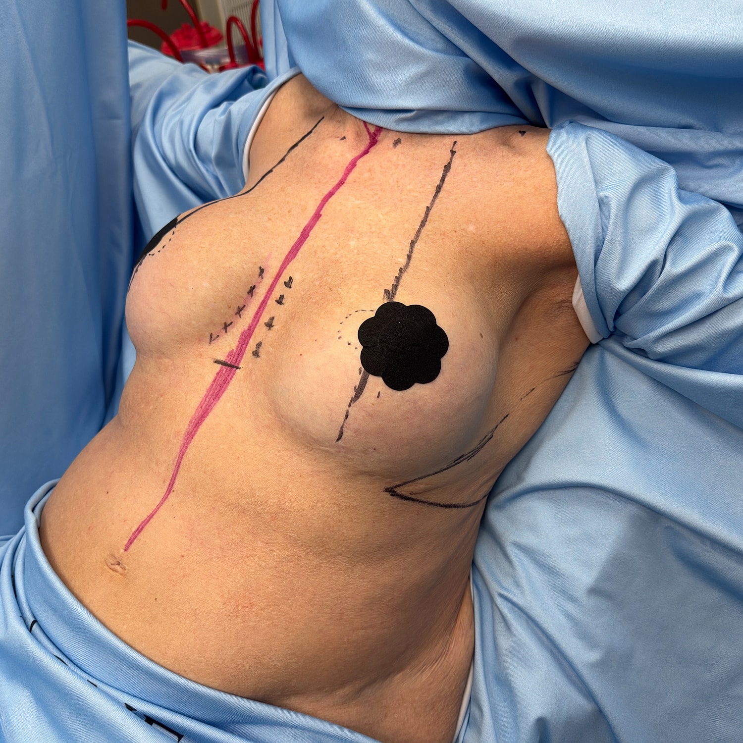 Surgical markings on chest for procedure preparation.