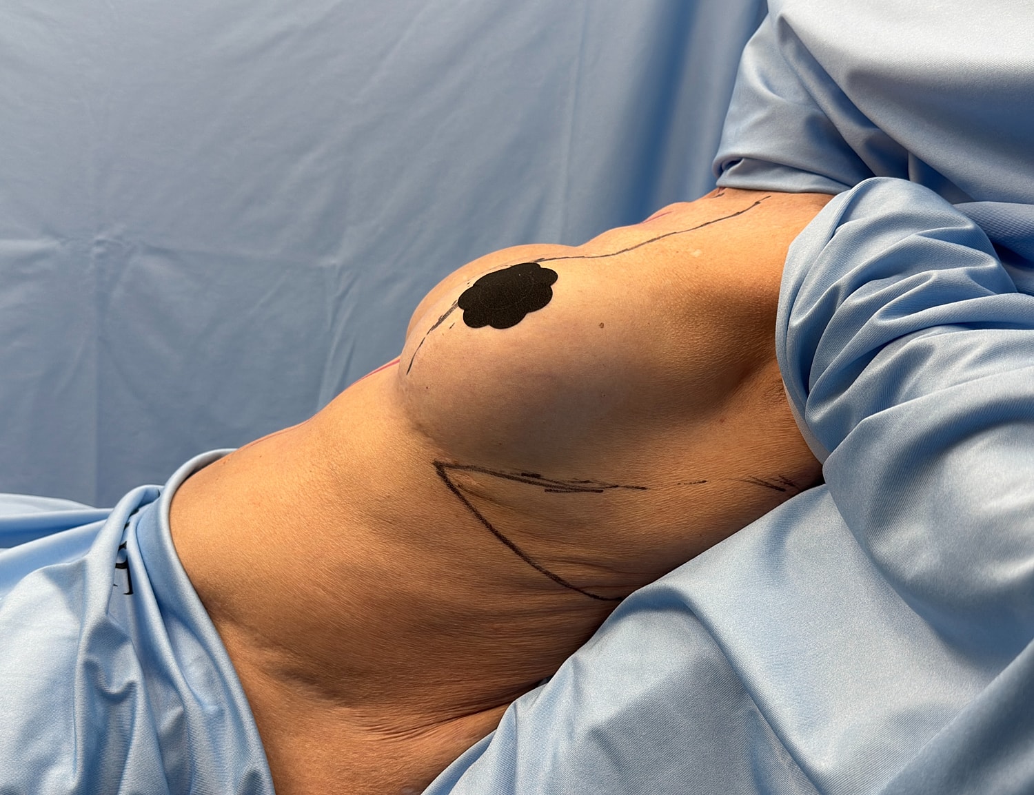 Medical marking on chest for surgical procedure.