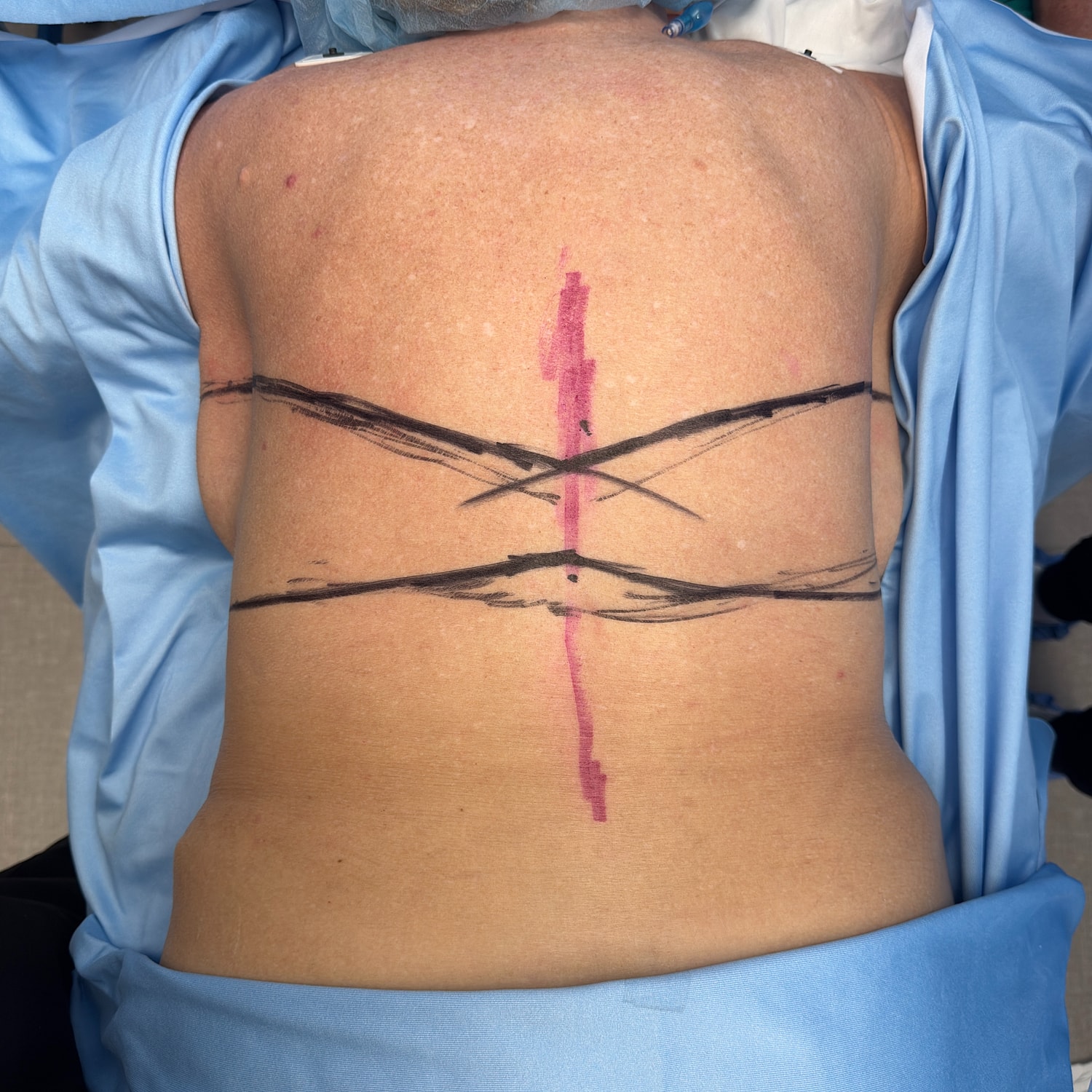 Surgical markings on a patient's back before procedure.