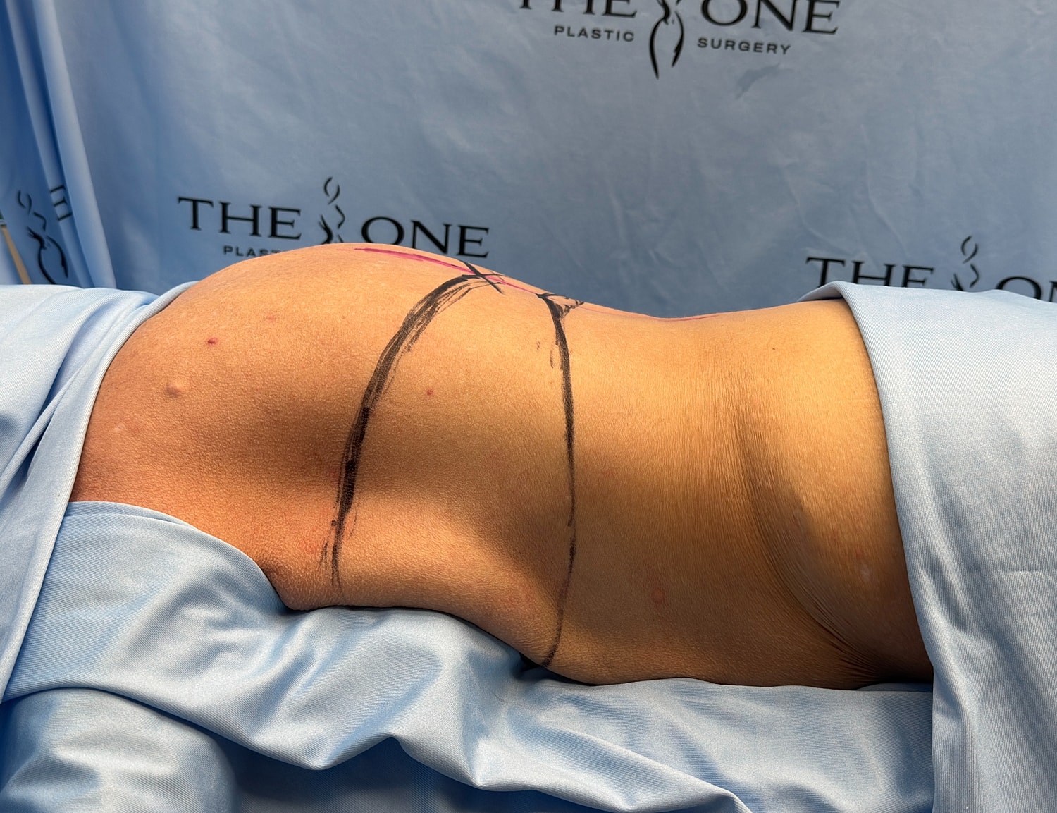 Pre-surgery markings on a patient's back.