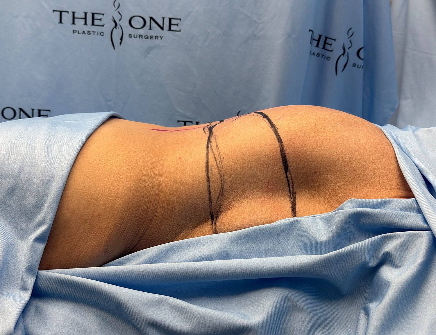 Surgical preparation for body contouring procedure.