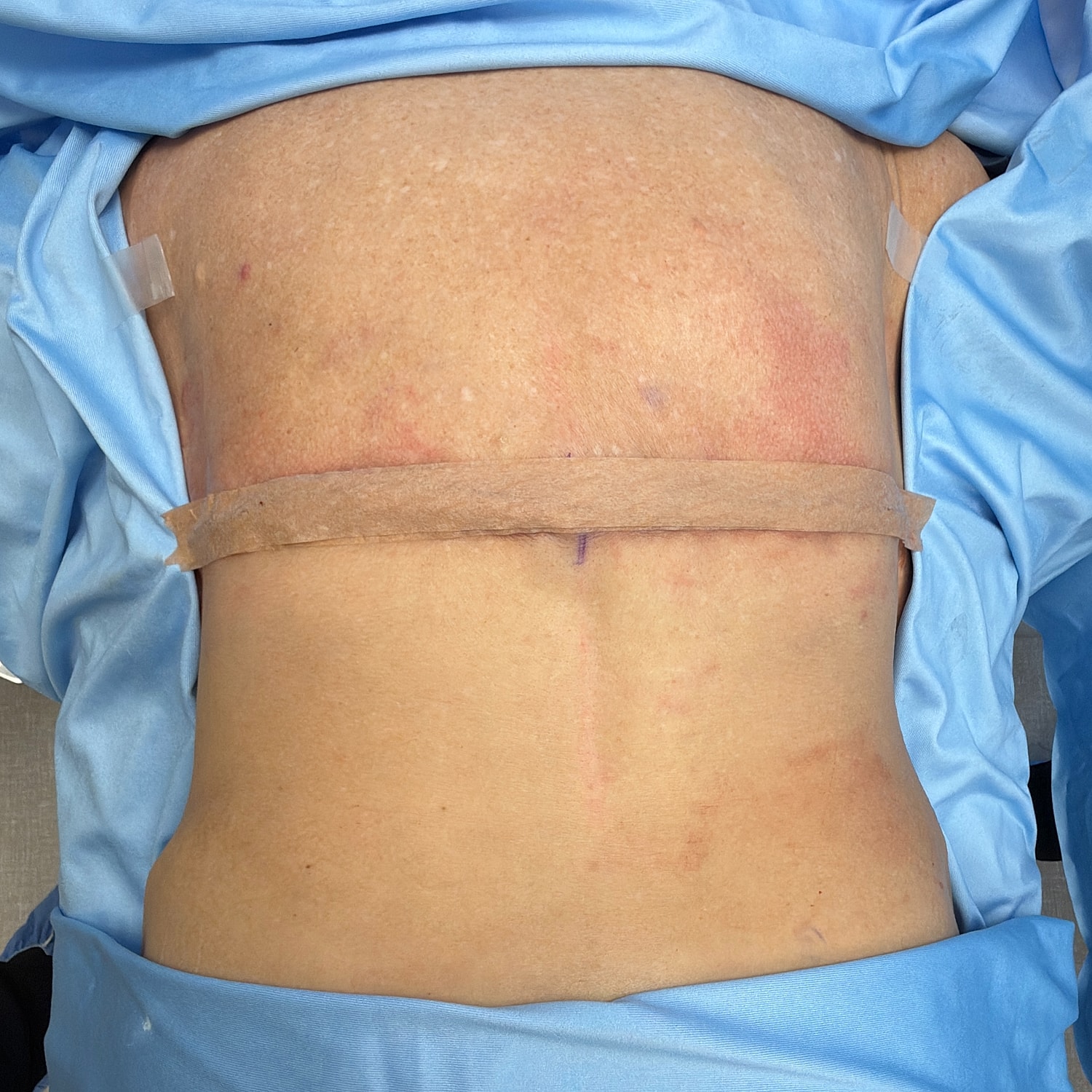 Patient's back with surgical markings and drapes.