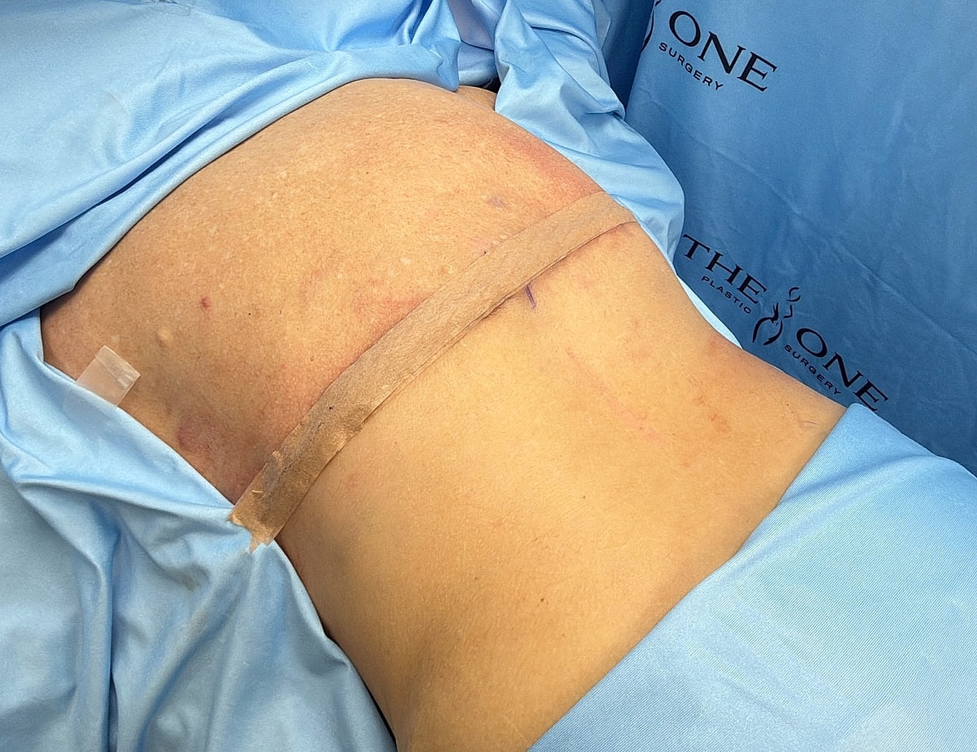 Post-surgery patient abdomen with dressings.