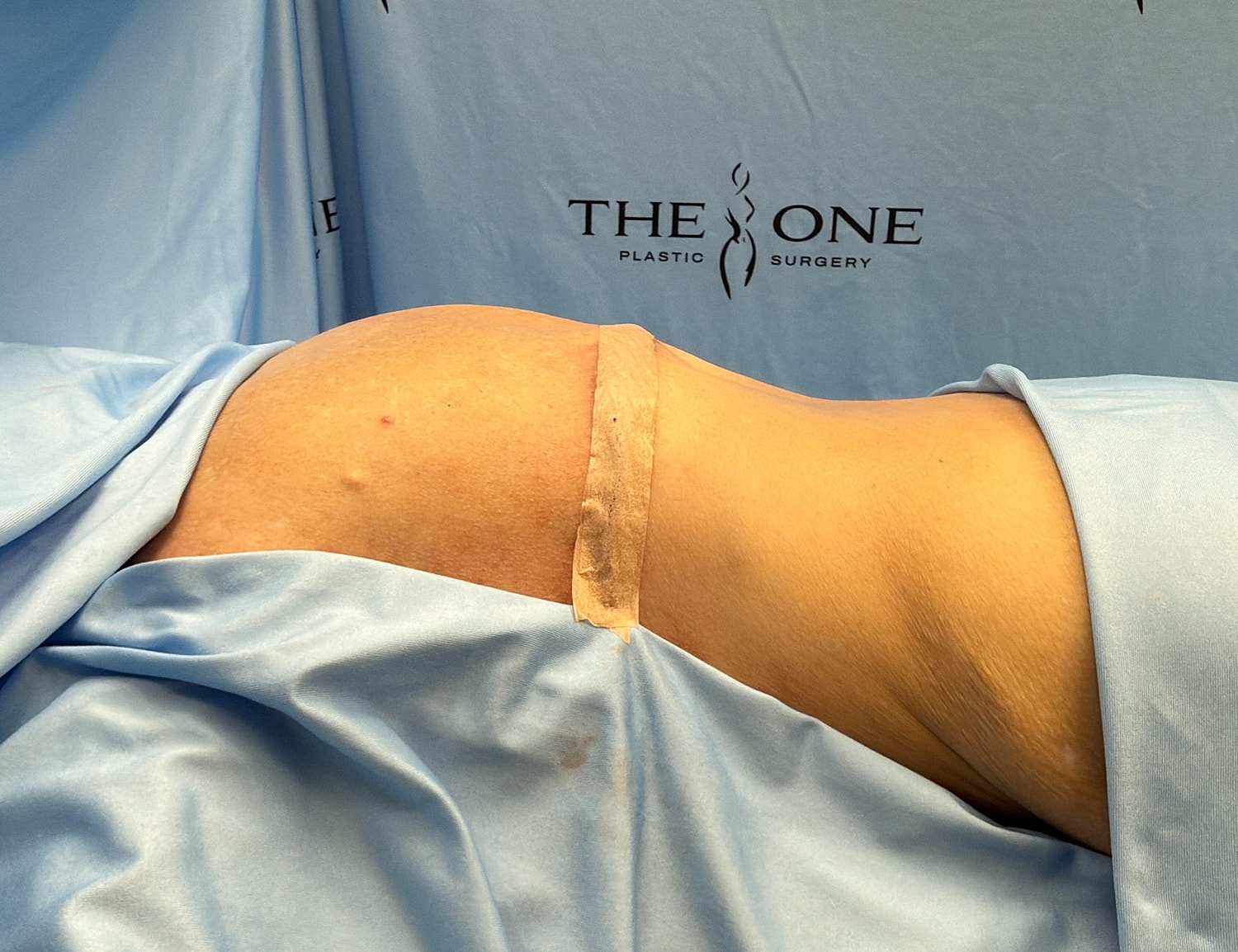 Post-surgery recovery with bandage on abdomen.