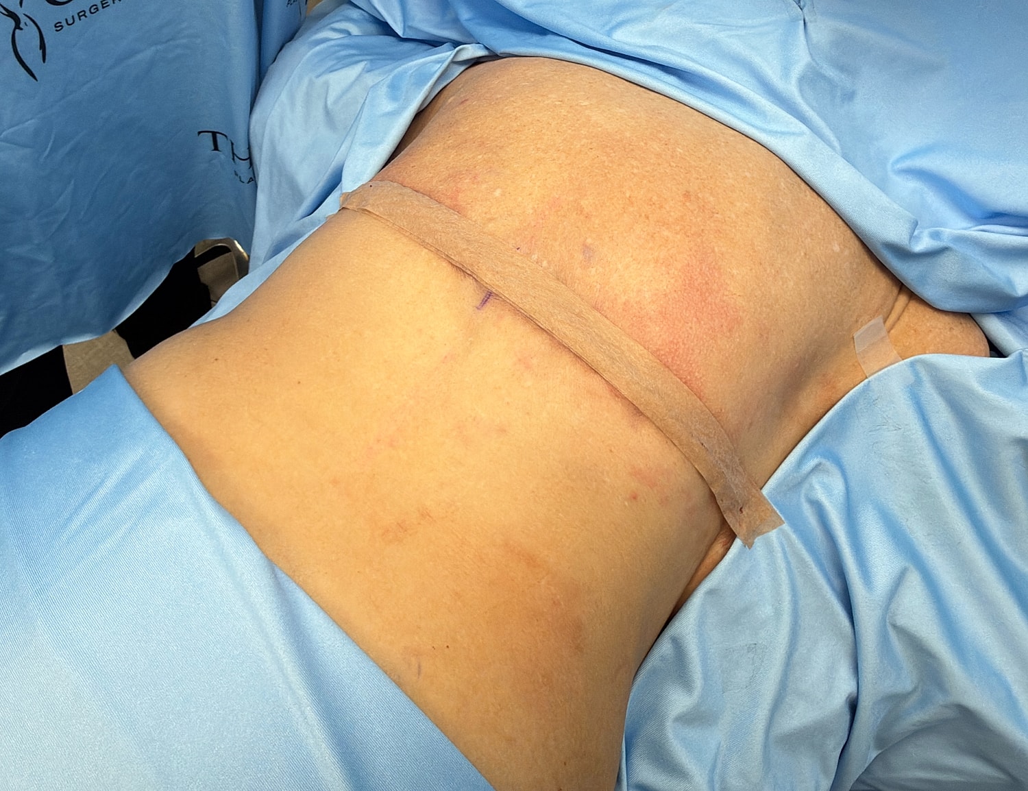 Patient's back in medical setting with monitoring devices.