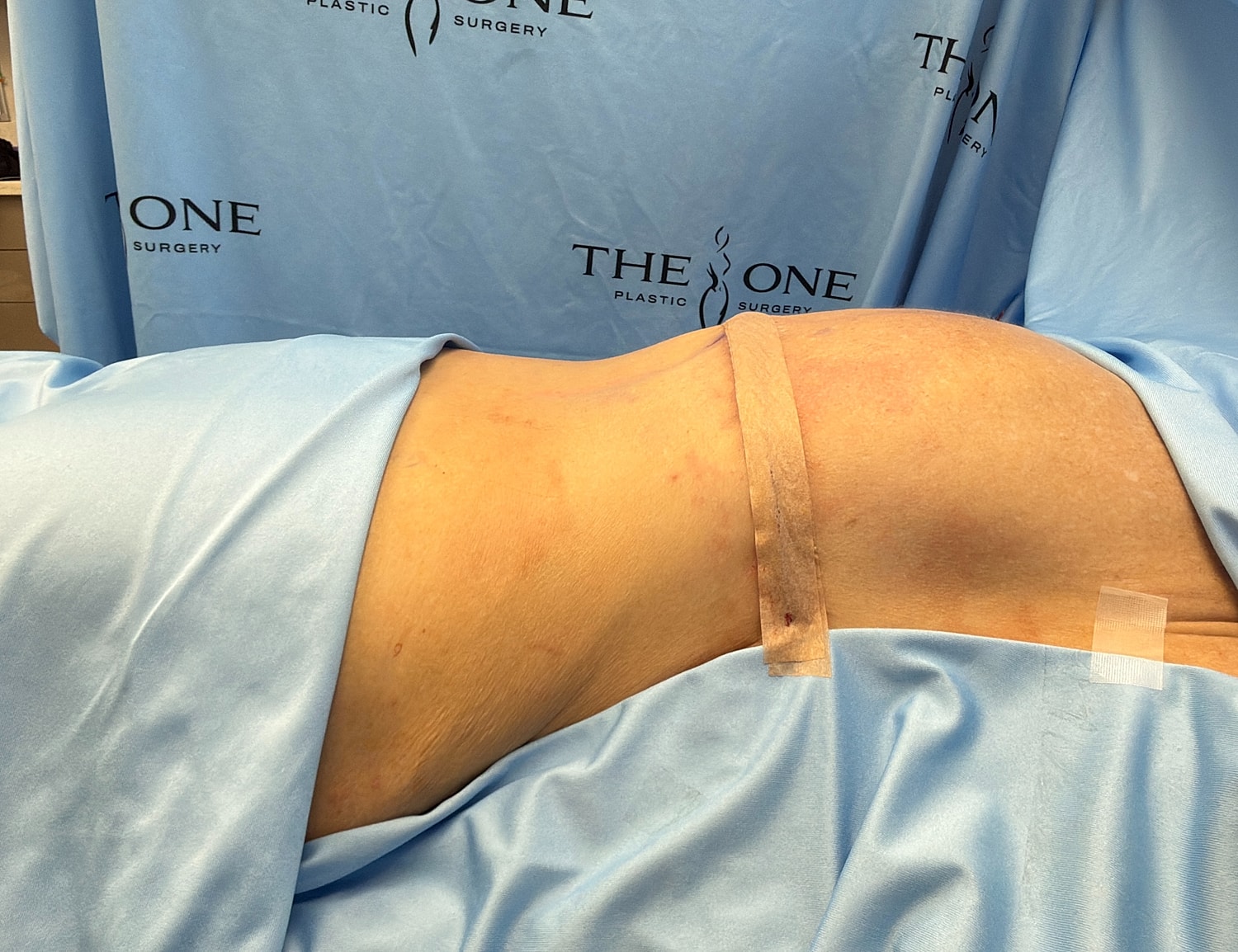 Surgical procedure preparations with blue drapes.